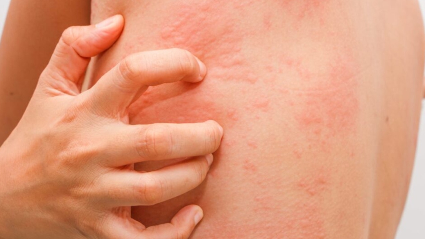 Причини появи алергії та її наслідки
